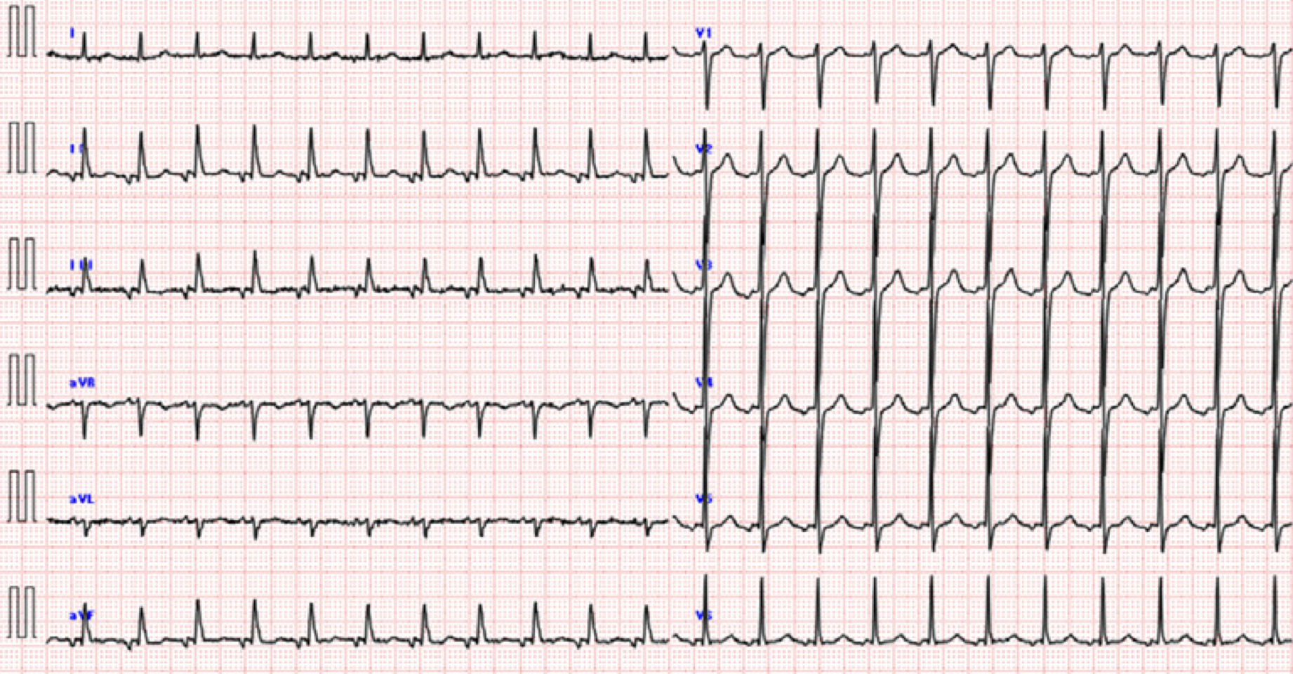 ATP感受性心房頻拍(ATP-sensitive atrial tachycardia)