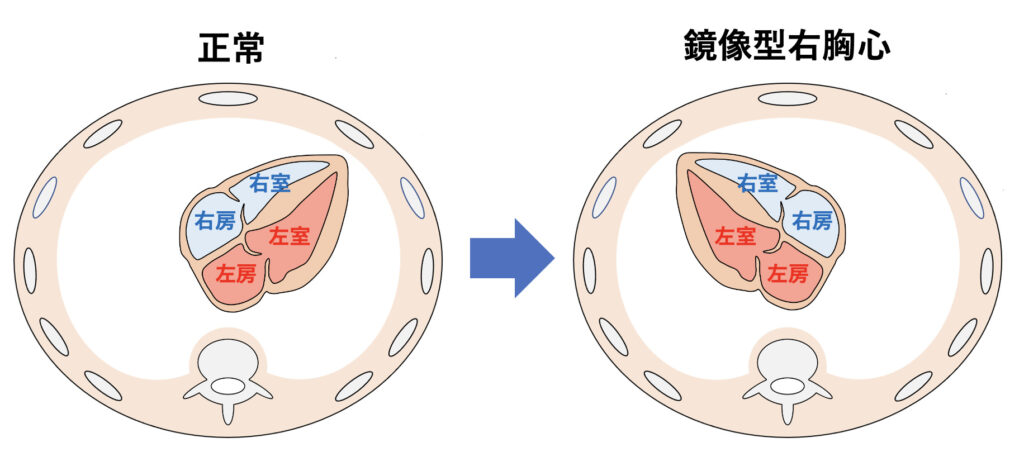 右胸心(dextrocardia)