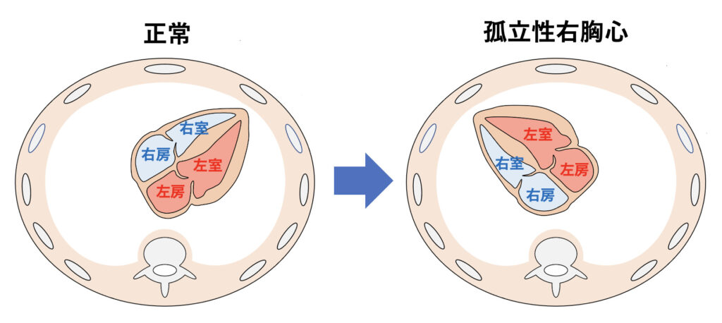 右胸心(dextrocardia)