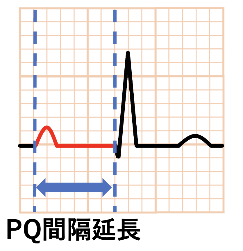 PQ間隔(PQ interval)