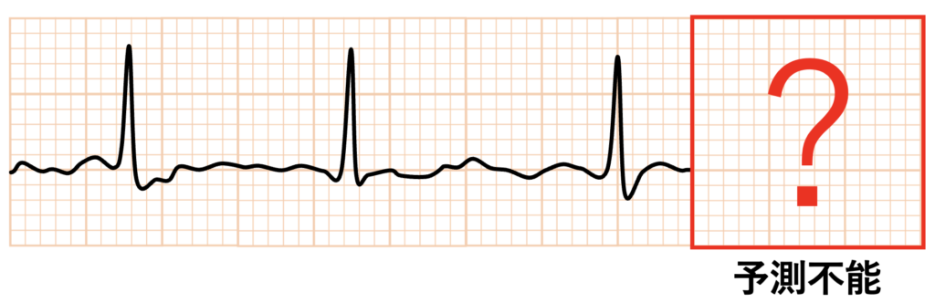 心房細動(Atrial fibrillation)