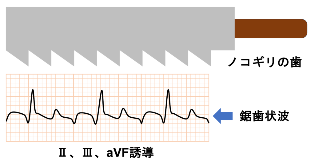 心房粗動(Atrial flutter)