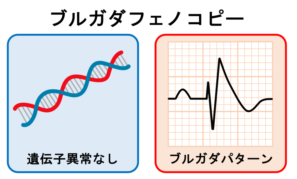 ブルガダフェノコピー(Brugada phencopy)
