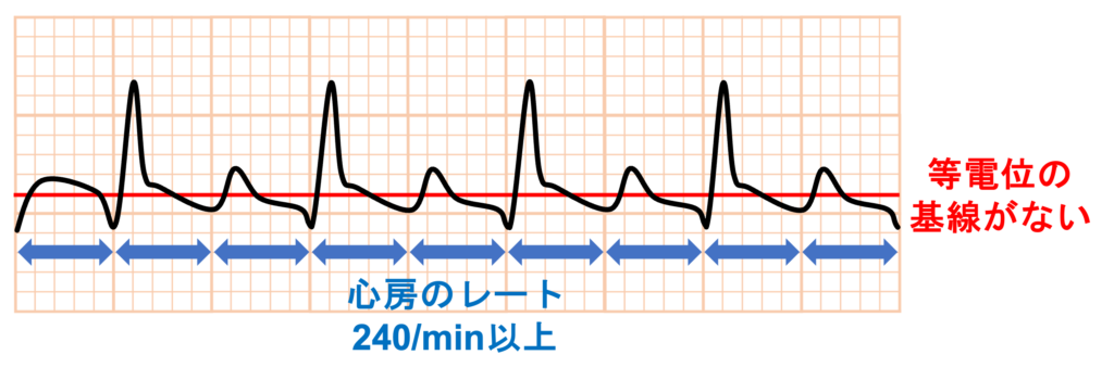 心房粗動(Atrial flutter)