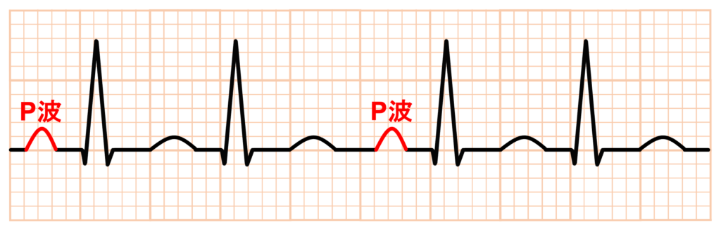 心室二重応答(double ventricular response)