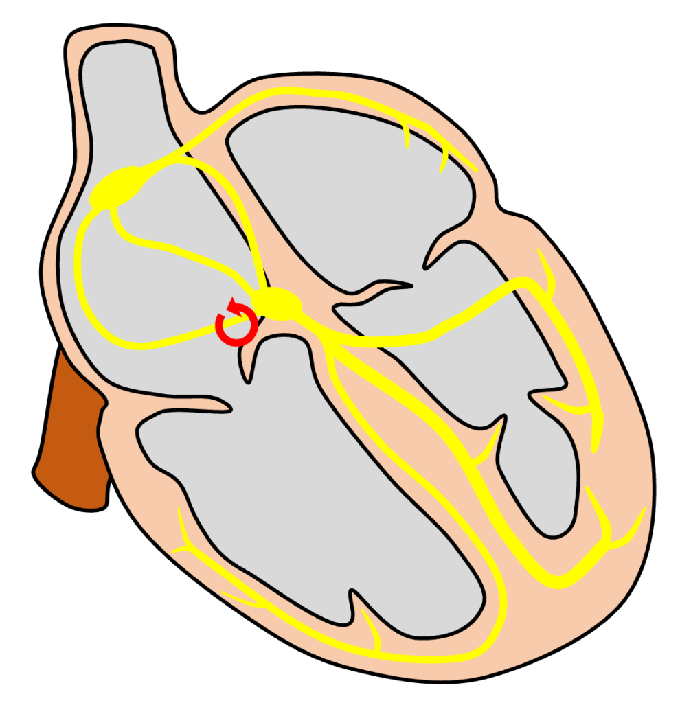 ATP感受性心房頻拍(ATP-sensitive atrial tachycardia)