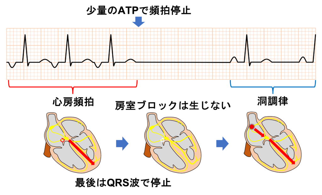 ATP感受性心房頻拍(ATP-sensitive atrial tachycardia)