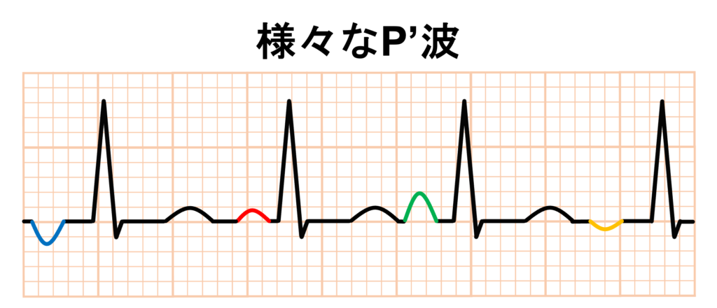 心房頻拍(atrial tachycardia)