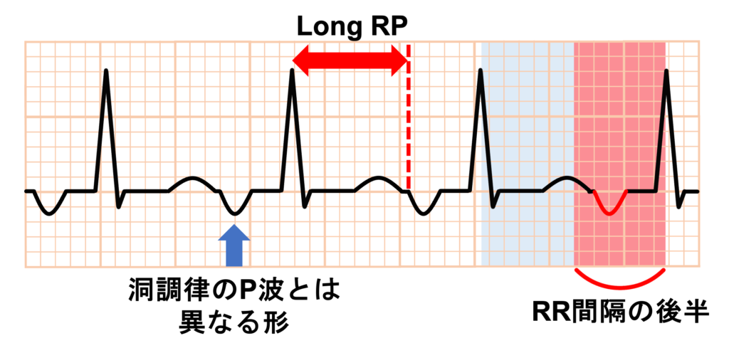 心房頻拍(atrial tachycardia)