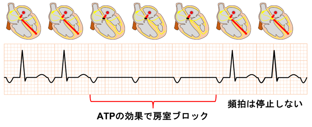 心房頻拍(atrial tachycardia)