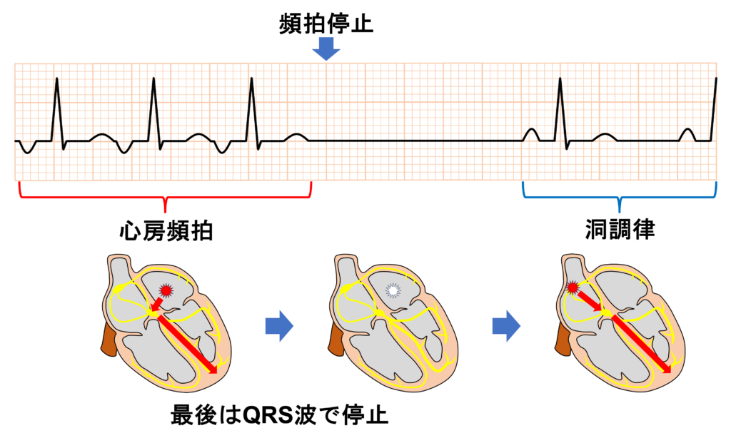 心房頻拍(atrial tachycardia)