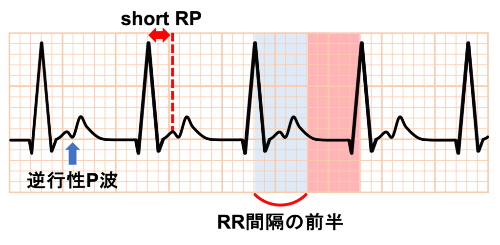 房室回帰性頻拍(atrioventricular reentrant tachycardia：AVRT)