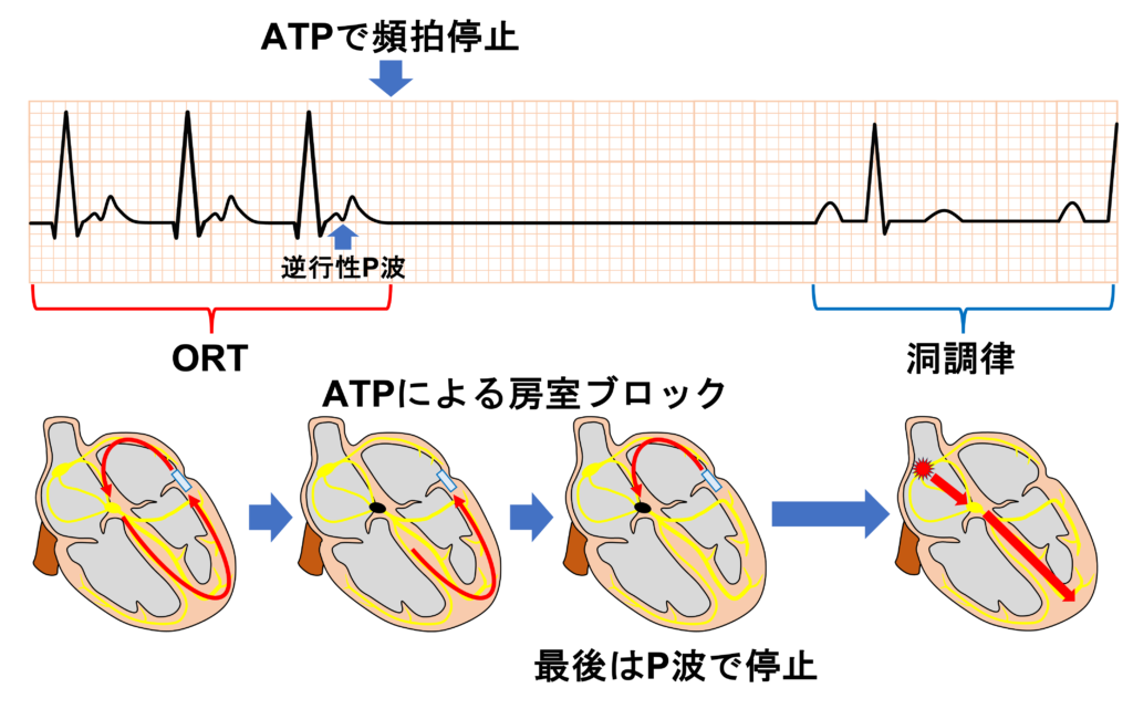 房室回帰性頻拍(atrioventricular reentrant tachycardia：AVRT)