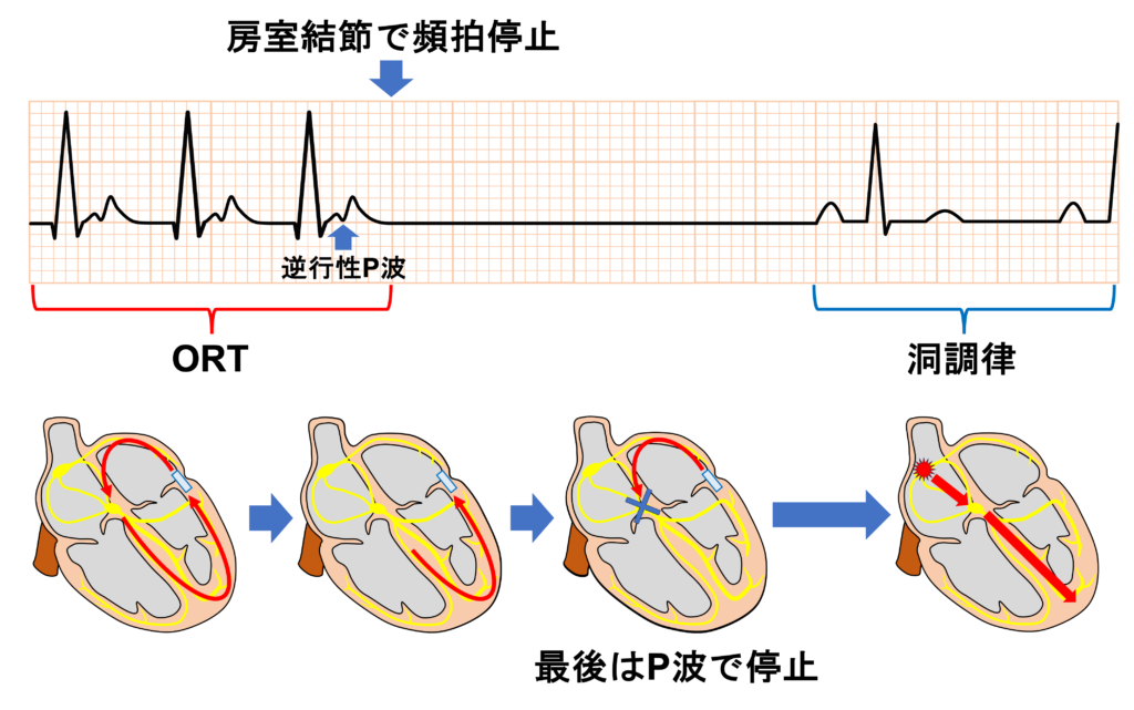 房室回帰性頻拍(atrioventricular reentrant tachycardia：AVRT)