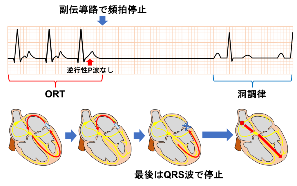 房室回帰性頻拍(atrioventricular reentrant tachycardia：AVRT)