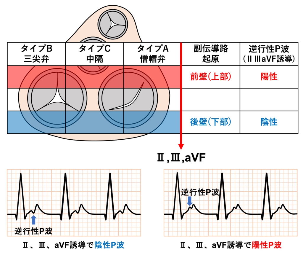 房室回帰性頻拍(atrioventricular reentrant tachycardia：AVRT)