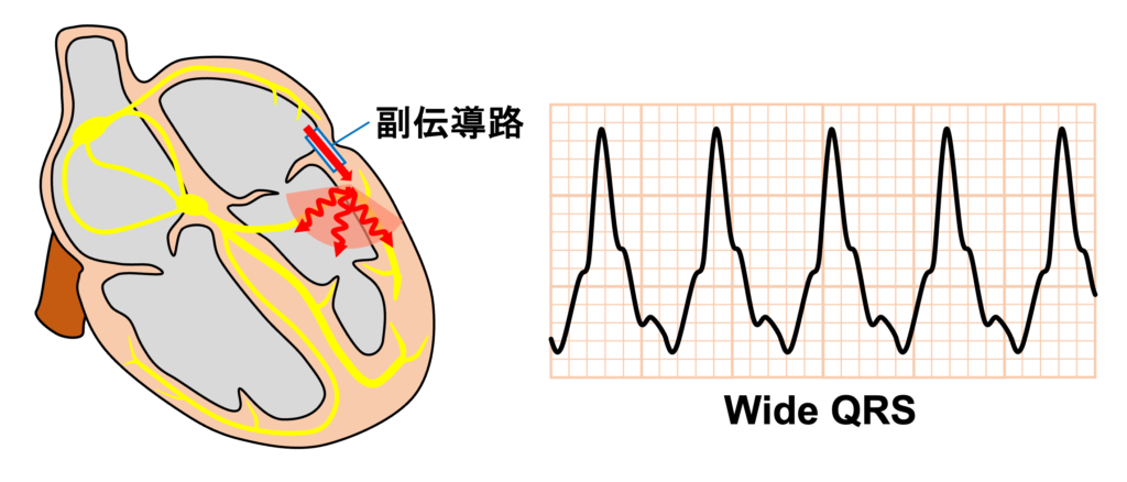 房室回帰性頻拍(atrioventricular reentrant tachycardia：AVRT)