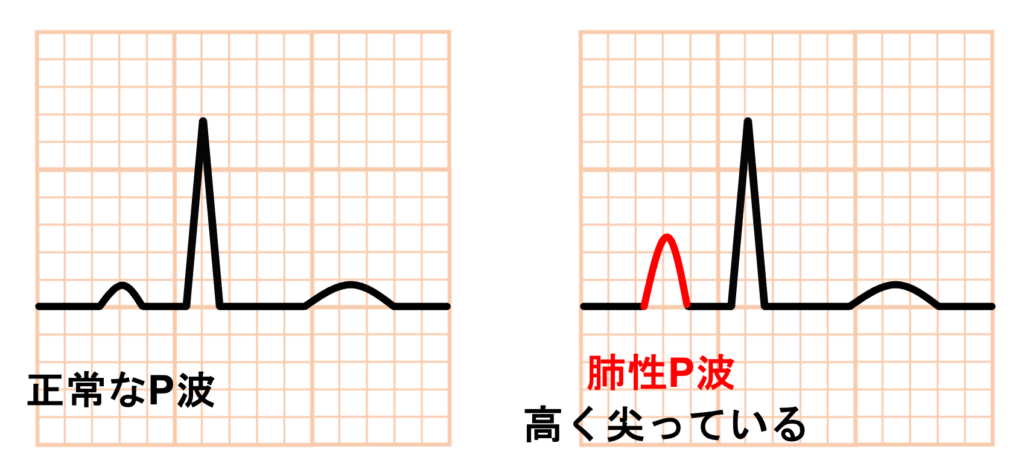 肺性P波(P pulmonale)