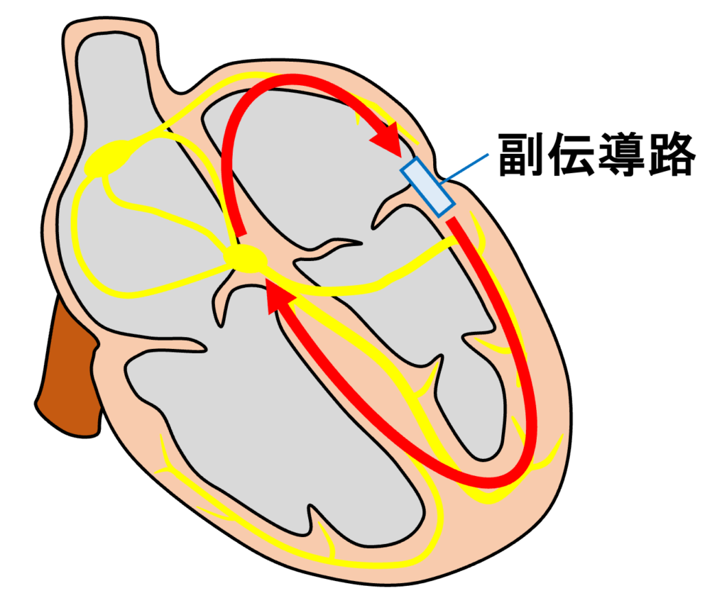 房室回帰性頻拍(atrioventricular reentrant tachycardia：AVRT)