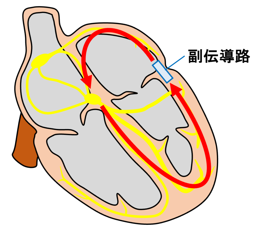 房室回帰性頻拍(atrioventricular reentrant tachycardia：AVRT)