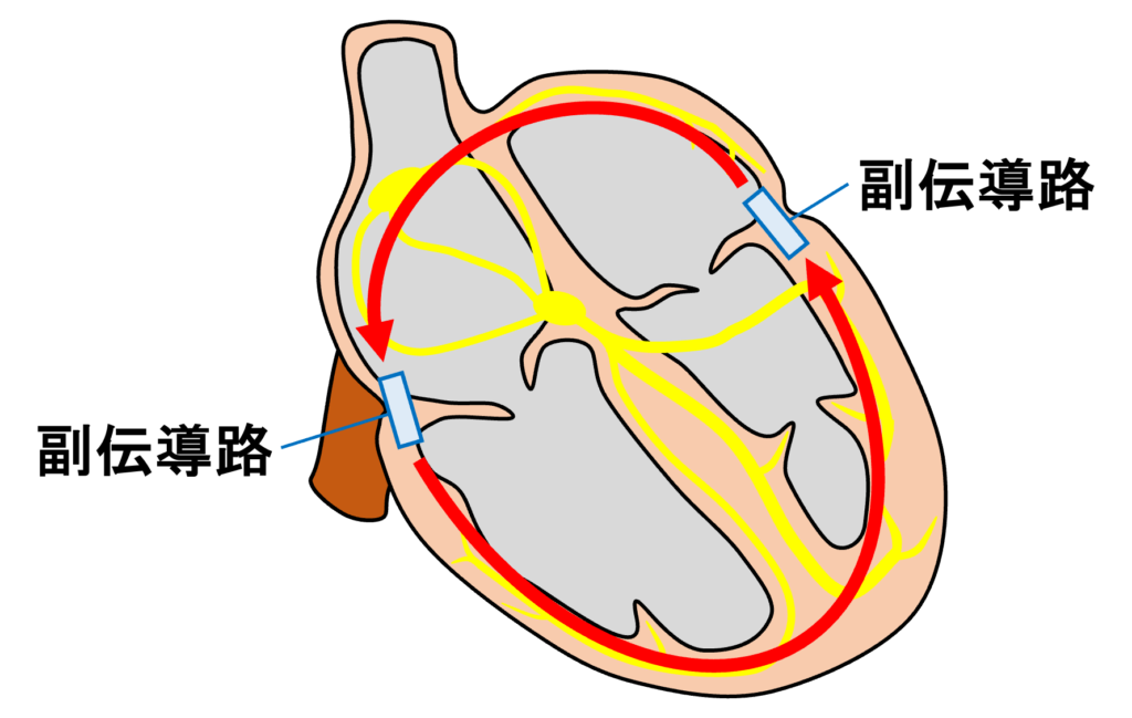 Bidirectional AVRT