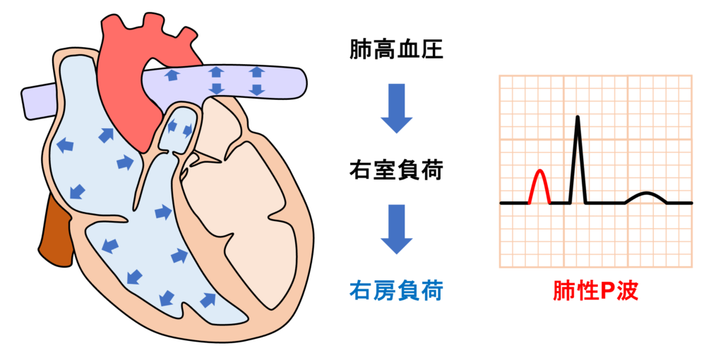 肺性P波(P pulmonale)