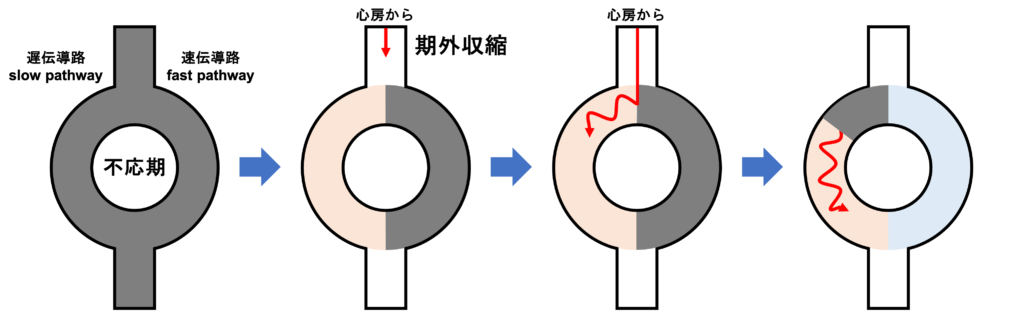 房室結節回帰性頻拍(atrioventricular nodal reentrant tachycardia:AVNRT)