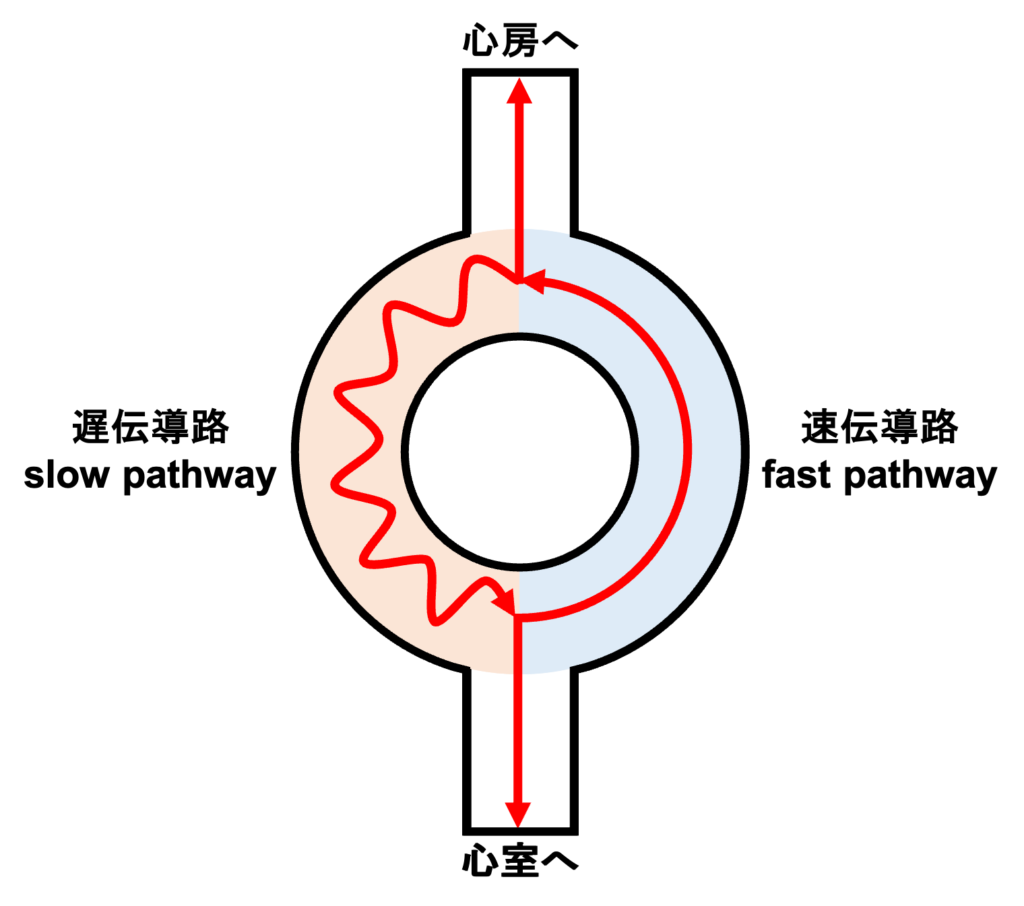 房室結節回帰性頻拍(atrioventricular nodal reentrant tachycardia:AVNRT)