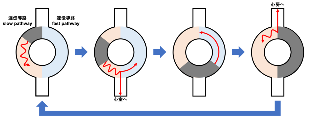 房室結節回帰性頻拍(atrioventricular nodal reentrant tachycardia:AVNRT)