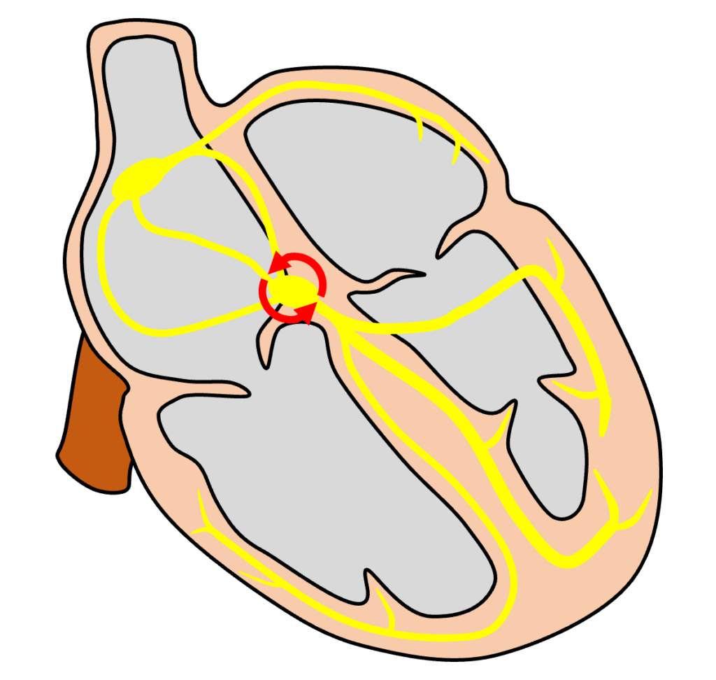 房室結節回帰性頻拍(atrioventricular nodal reentrant tachycardia:AVNRT)