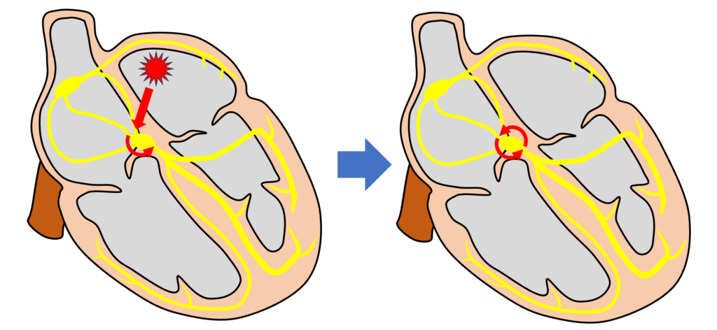 房室結節回帰性頻拍(atrioventricular nodal reentrant tachycardia:AVNRT)