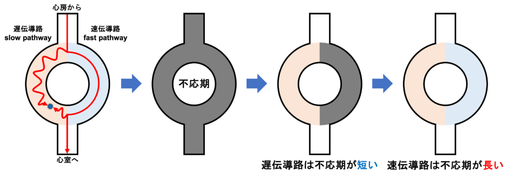 房室結節回帰性頻拍(atrioventricular nodal reentrant tachycardia:AVNRT)