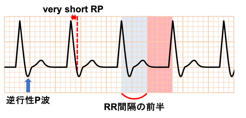 房室結節回帰性頻拍(atrioventricular nodal reentrant tachycardia:AVNRT)