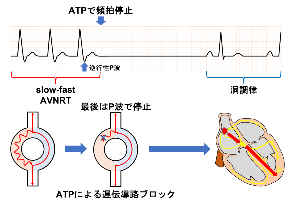 房室結節回帰性頻拍(atrioventricular nodal reentrant tachycardia:AVNRT)