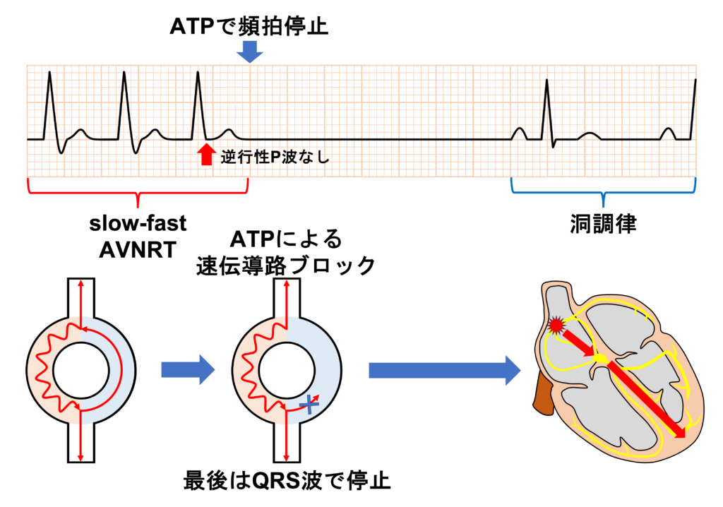 房室結節回帰性頻拍(atrioventricular nodal reentrant tachycardia:AVNRT)