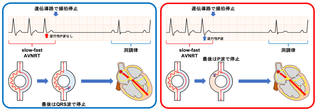 房室結節回帰性頻拍(atrioventricular nodal reentrant tachycardia:AVNRT)