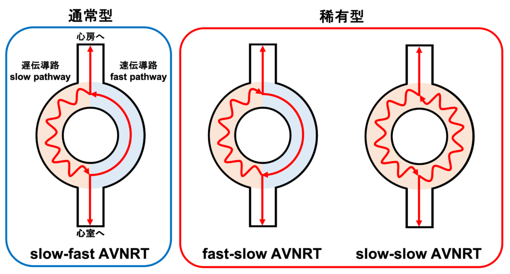 房室結節回帰性頻拍(atrioventricular nodal reentrant tachycardia:AVNRT)