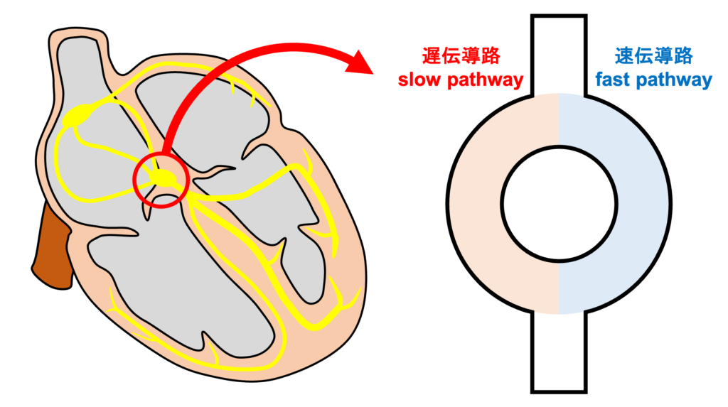 房室結節回帰性頻拍(atrioventricular nodal reentrant tachycardia:AVNRT)