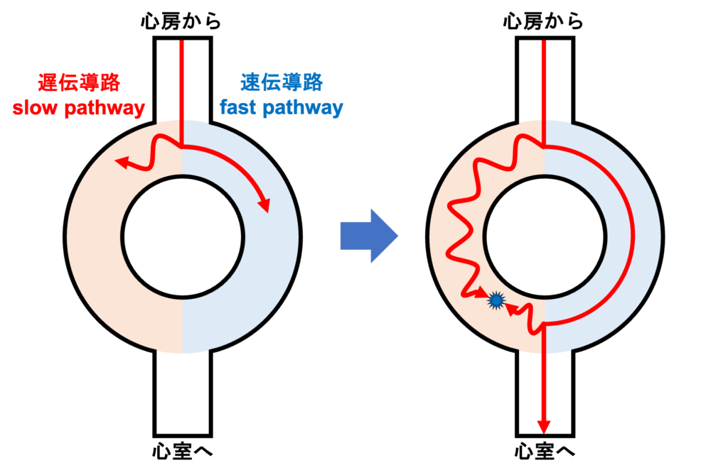 房室結節回帰性頻拍(atrioventricular nodal reentrant tachycardia:AVNRT)