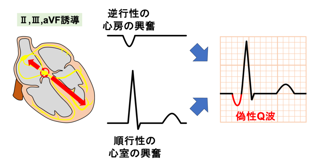 房室結節回帰性頻拍(atrioventricular nodal reentrant tachycardia:AVNRT)