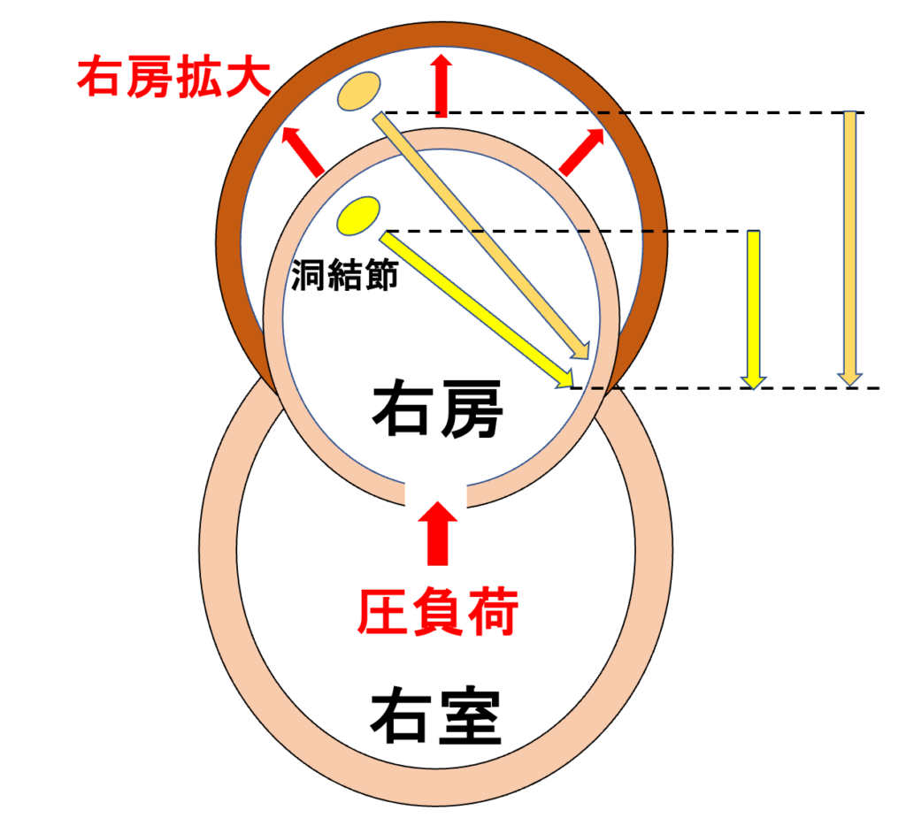 肺性P波(P pulmonale)