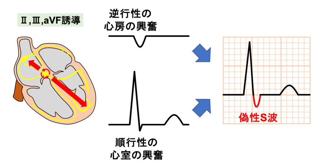 房室結節回帰性頻拍(atrioventricular nodal reentrant tachycardia:AVNRT)