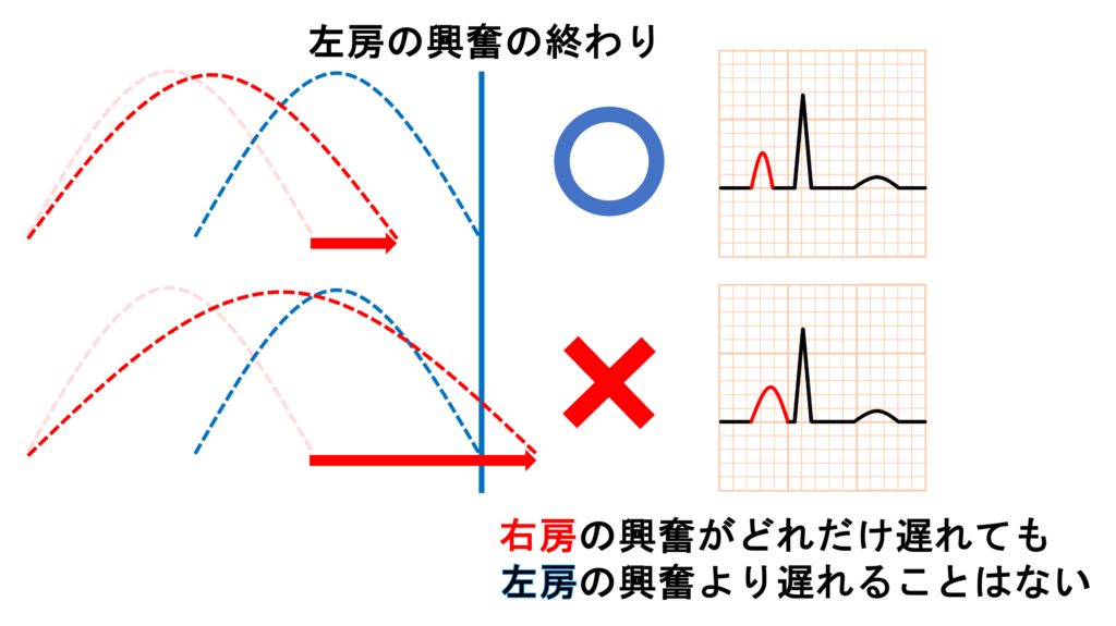 肺性P波(P pulmonale)