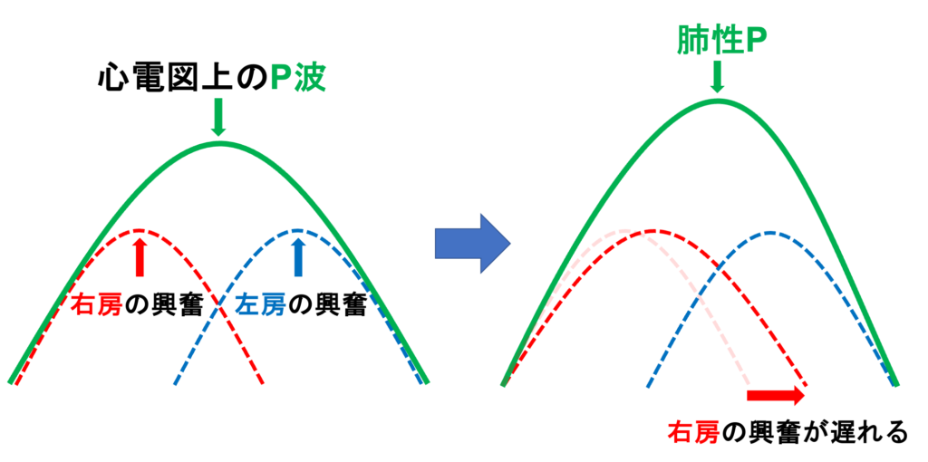 肺性P波(P pulmonale)