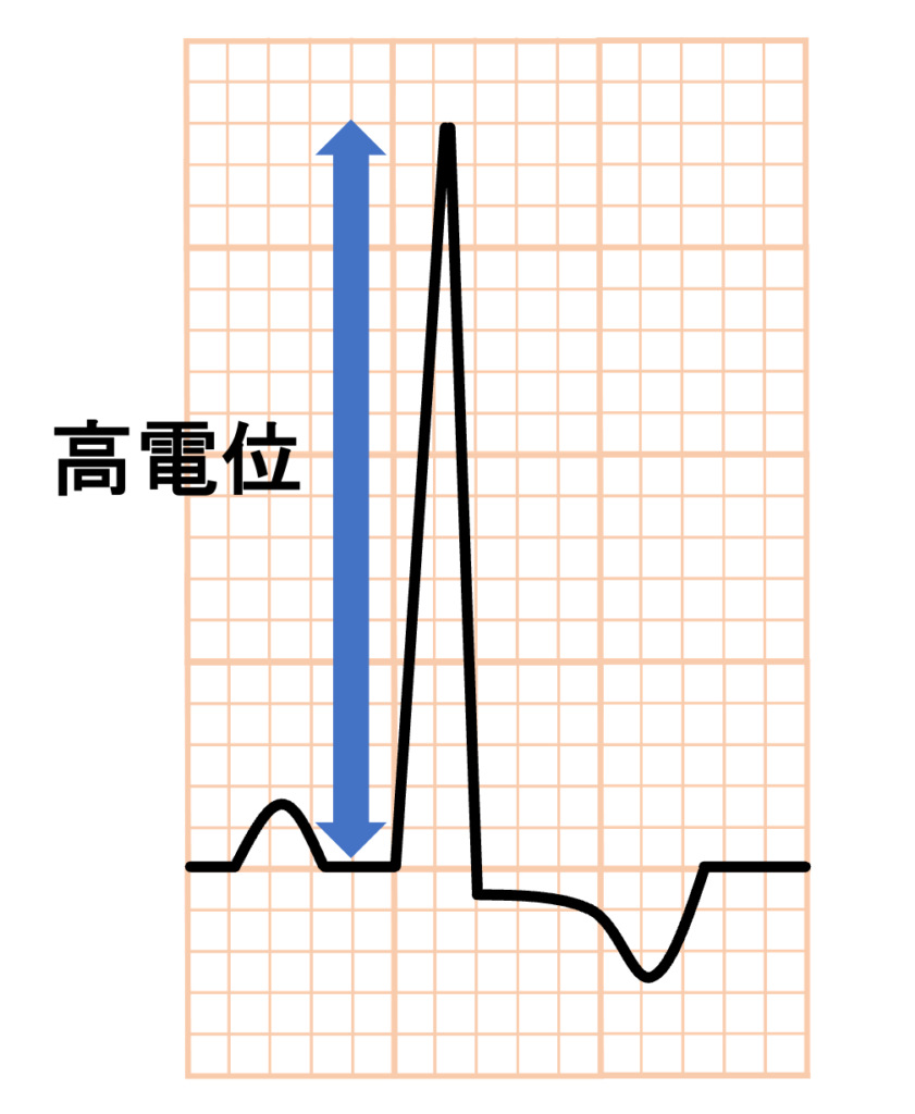 左室肥大(left ventricular hypertrophy)