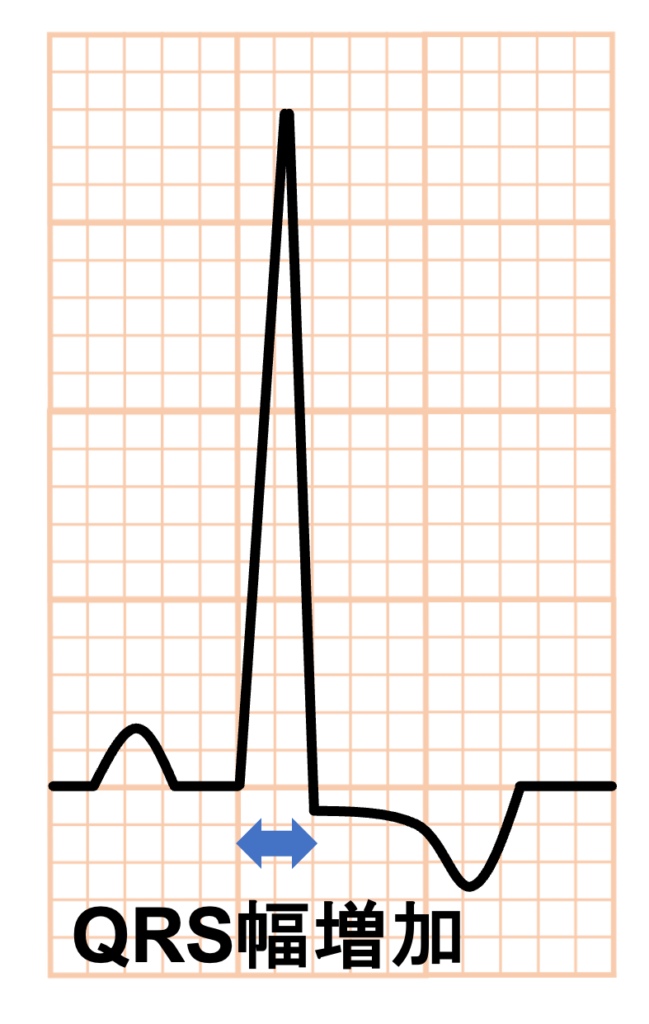 左室肥大(left ventricular hypertrophy)