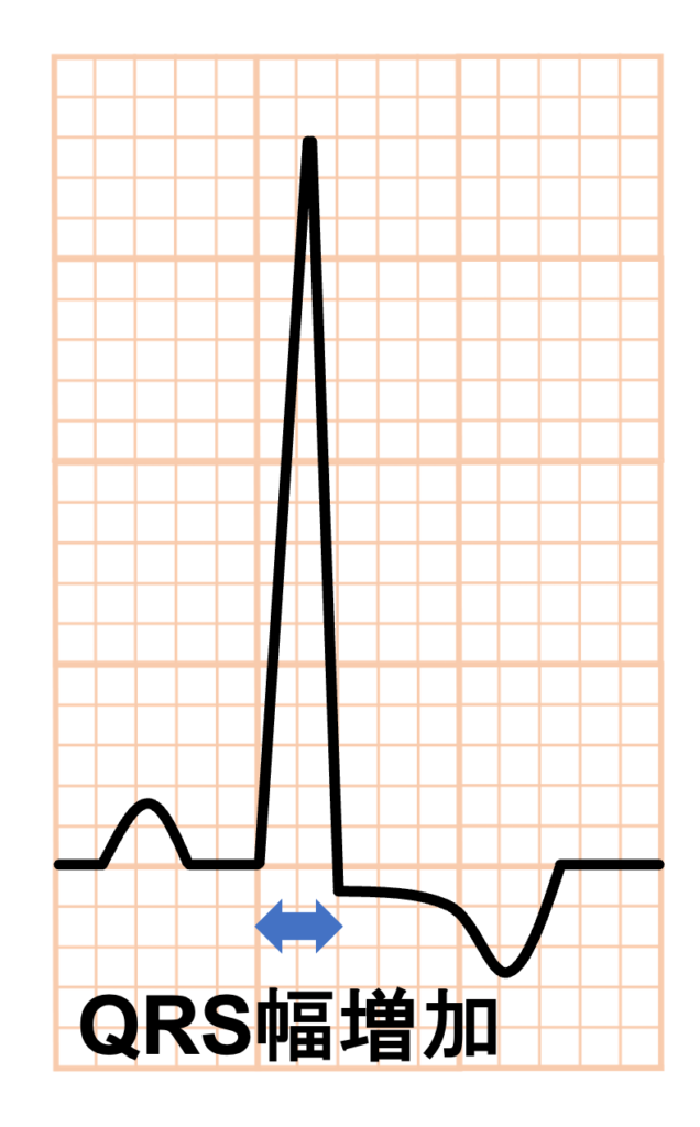 左室肥大(left ventricular hypertrophy)