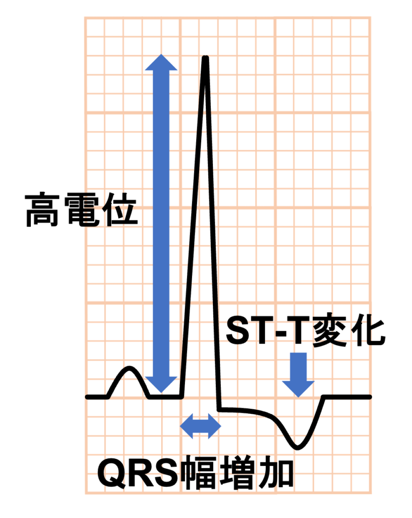 左室肥大(left ventricular hypertrophy)