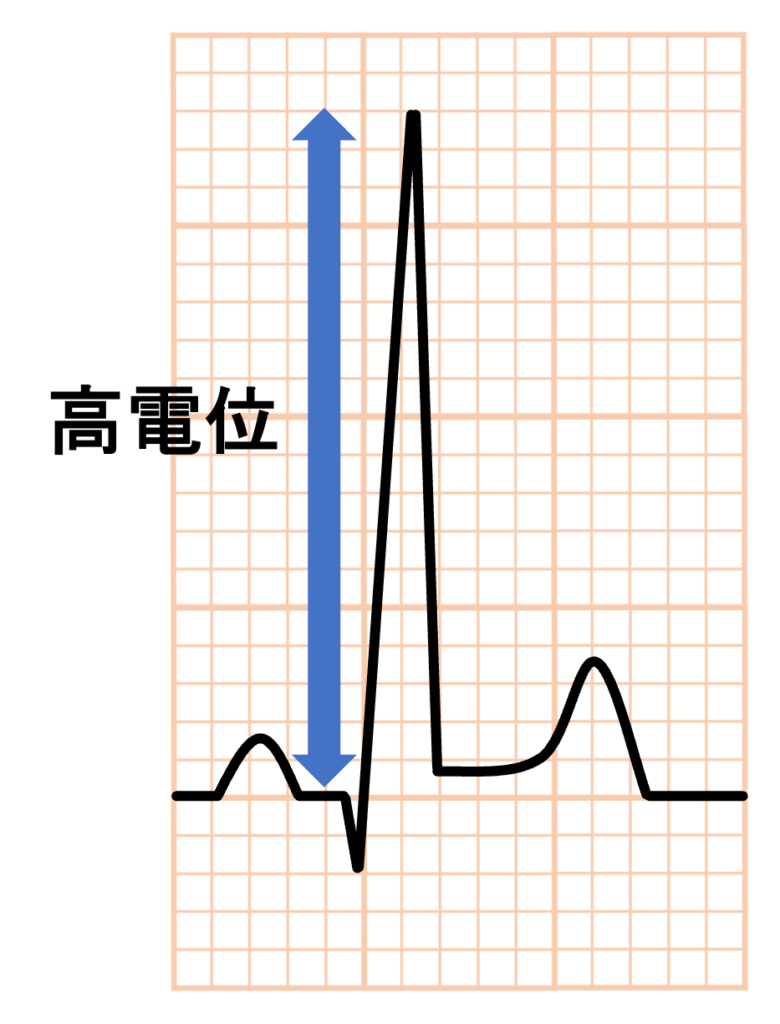 左室容量負荷(left ventricular volume overload)