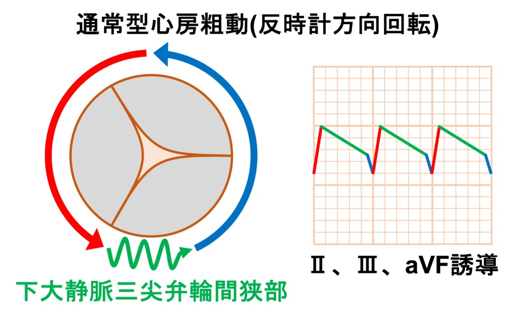 心房粗動(Atrial flutter)